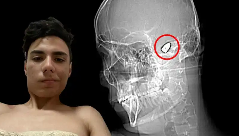 Kafasında Patlayıcı Bulunan Adamın Hayatı: Tehlikenin Eşiğinde